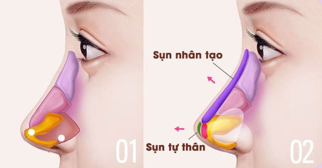 Các loại nâng mũi phổ biến hiện nay