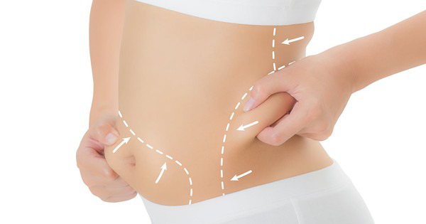 Phẫu thuật cắt da thừa bụng là gì?