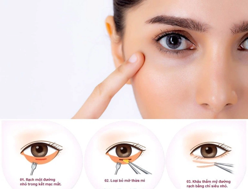 Cắt mí dưới là gì? Những thông tin cần biết trước khi phẫu thuật cắt mí ...
